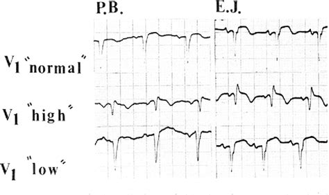 Figure 1 From Left Anterior Hemiblock Obscuring The Diagnosis Of Right