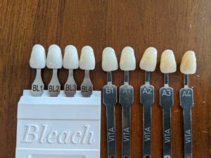 The Whitest Tooth Color For Veneers Images Video Afterva Oral