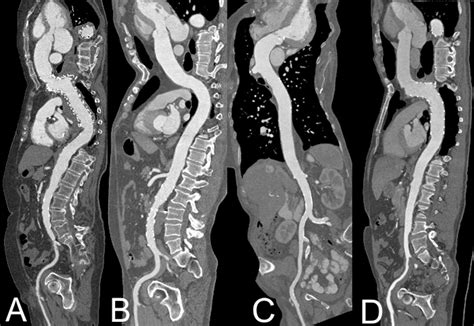 Bolus Timing In High Pitch Ct Angiography Of The Aorta European