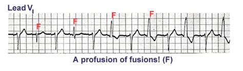 fusion beats wikidoc