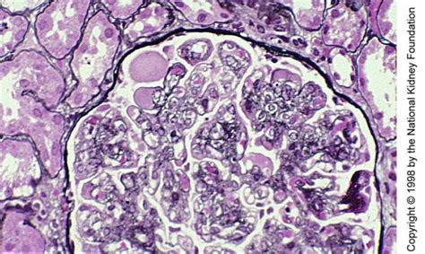 Image Glomerulonefritis Membranoproliferativa Mediada Por