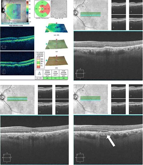 Spectral Domain Optical Coherence Tomography Scans Showing Recurrent Download Scientific