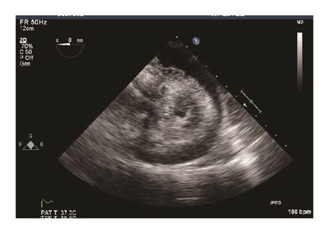 Echocardiography With Pericardial Effusion Download Scientific Diagram