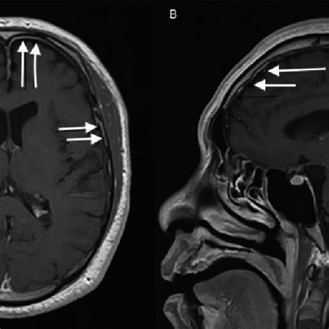 CT brain with Contrast, CT Angiogram Fig. 1a: CT Brain with contrast ...