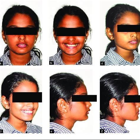 Posttreatment Extraoral Photographs A Frontal B Frontal Smiling