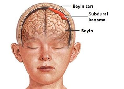 Beyin Kanaması Beyin Kanaması Belirtileri ve Tedavisi Doğal Tıp