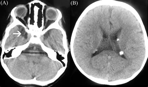 Figure 1 From Bilateral Temporal Arachnoid Cysts Associated With