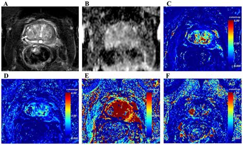 Application Evaluation Of DCEMRI Combined With Quantitative Analysis