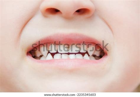 Imagens De Crian A Dente Manchado Imagens Fotos Stock E Vetores