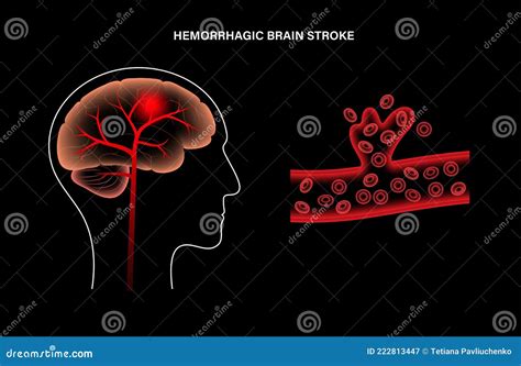 Brain Stroke Hemorrhagic Stock Vector Illustration Of Cardiovascular 222813447