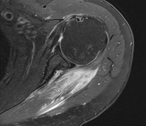 Axial T2 MRI Of The Left Shoulder Demonstrating Hyperintensity