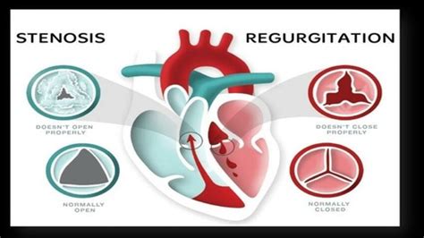 Valve Disease Flashcards Quizlet
