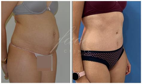 Abdominoplastia Que Es Indicaciones Y Precios Face Clinic