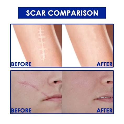 Surgical Scars Removal Cream Burn Scars Remover cream