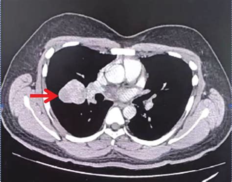 Contrast Enhanced Computed Tomography Thorax Showed Relatively