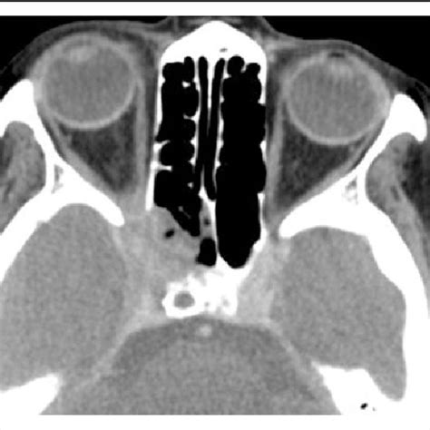 The Ethmoid Sinusitis In Computed Tomography Ct Scan Of One Patient