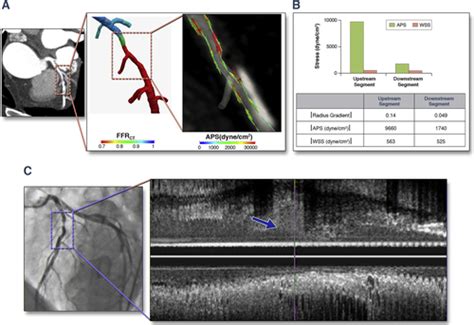 Coronary Artery Axial Plaque Stress And Its Relationship With Lesion