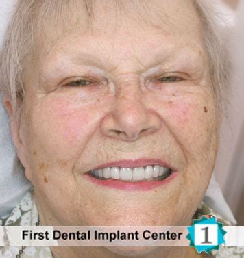 Affordable Dental Implants Woodland Hills Thousand Oaks Simi Valley