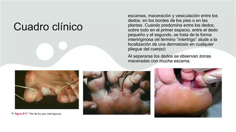 MICOSIS CUTANEAS SUPERFICIALES Pptx