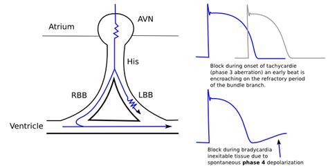 File Lbbb Phase3 Phase4 Svg Ecgpedia