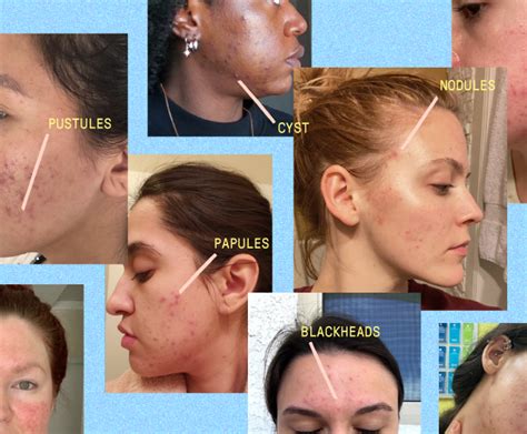 The Six Main Types Of Acne Apostrophe