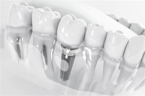 What Are The Possible Side Effects Of Dental Implants