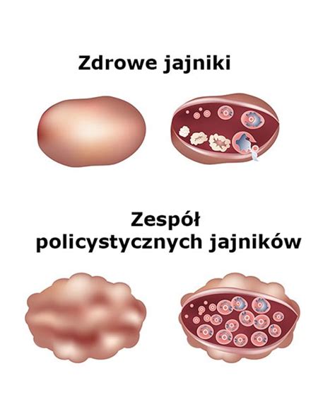 Zesp Policystycznych Jajnik W Pcos Alfa Lek