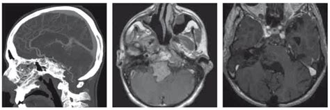 Scielo Brasil Nuances In The Treatment Of Malignant Tumors Of The