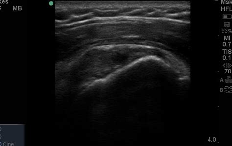 Longitudinal view of a Supraspinatus tear