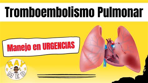 TROMBOEMBOLISMO PULMONAR Definición fisiopatología y presentación