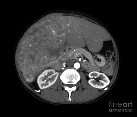 Liver Cancer CT Scan