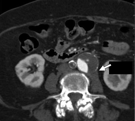 Abdominal Aortic Aneurysms Revisited MDCT With Multiplanar