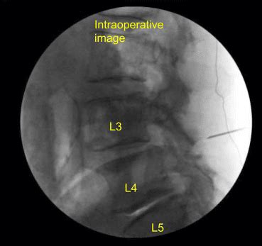 L L Bilateral Laminotomies Complete Orthopedics Ny