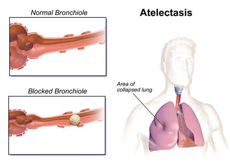 Verschil Tussen Atelectasis En Pneumothorax Ziekten