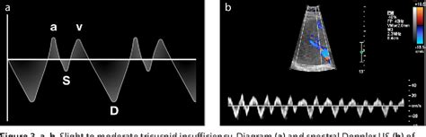 Figure 3 From Congestive Hepatopathy The Role Of The Radiologist In The Diagnosis Semantic