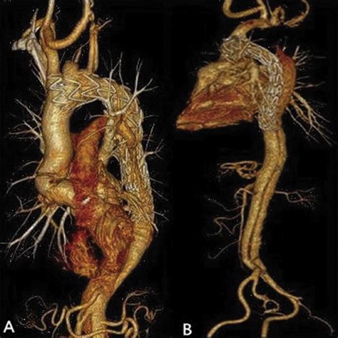 A Simplified Arch Debranching Technique For Hybrid Repair Of