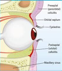 Orbital Cellulitis Flashcards Quizlet