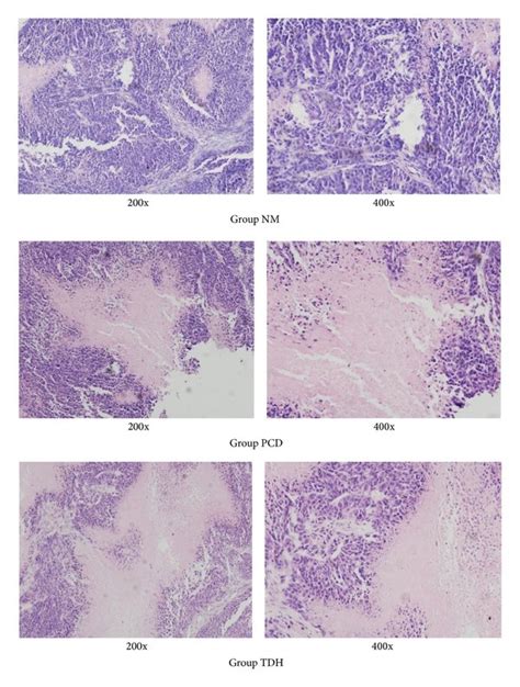 Pcna Expression In Tumor Tissues Assayed With Immunohistochemical