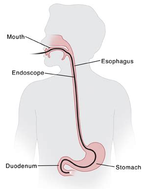 Upper GI Endoscopy with Biopsy | Saint Luke's Health System