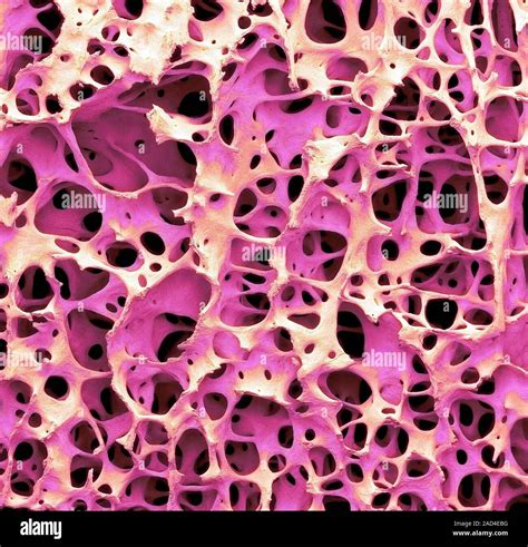 Bone Tissue Coloured Scanning Electron Micrograph Sem Of Cancellous