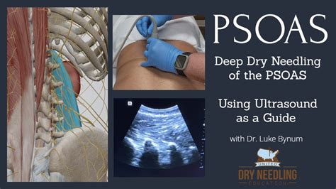 Psoas Dry Needling Using Ultrasound As A Guide Youtube