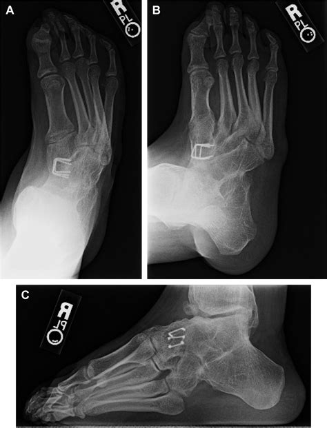 Triple Arthrodesis Foot And Ankle Clinics