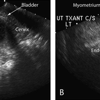 Bladder Flap Hematoma Coronal A And Sagittal B Cect Images Show A