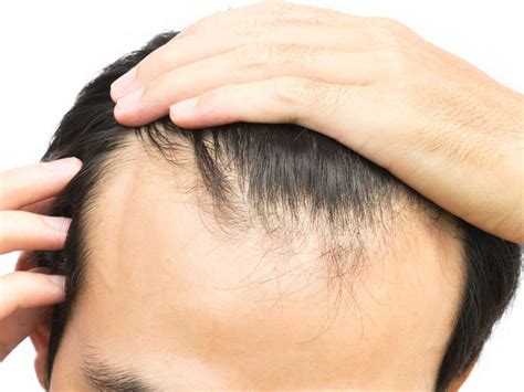 The Receding Hairline Stages For Men And Women Ds Healthcare Group