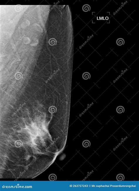 X Ray Digital Mammogram Or Mammography Of Both Side Breast Showing