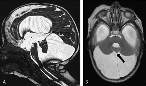 Sagittal 3d Ciss A And Axial T2 Weighted Mris B Of A 2 Year Old Download Scientific Diagram