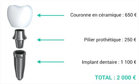 Full Mouth Dental Implants Cost Average Prices In 2023