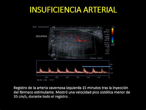 Figure 20 from ECOGRAFÍA DOPPLER PENEANA EN EL ESTUDIO DE LA DISFUNCIÓN