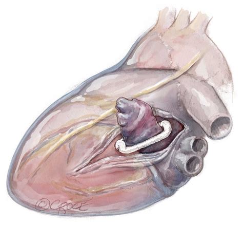 Atriclip Left Atrial Appendage Closure Gold Coast