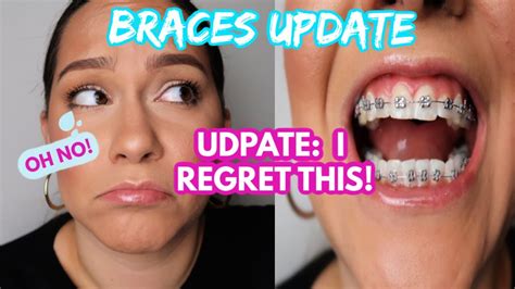 Braces Update 3 Month Update Lots Of Progress 2020 Youtube